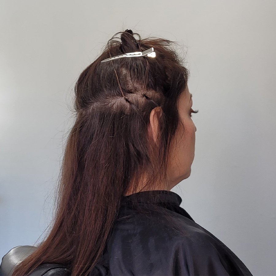 Woman with female pattern hair loss before IHS Link System